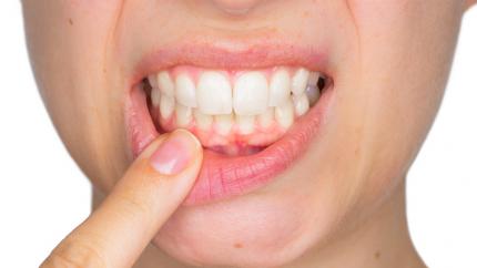 Colletti dentali scoperti