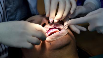 Erosione dentale