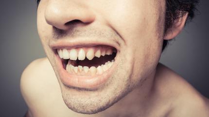Tartaro denti