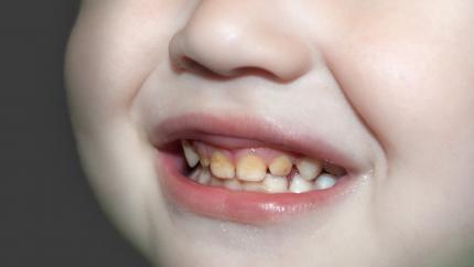 Macchie gialle sui denti