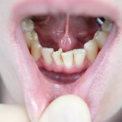 Affollamento dentale grave
