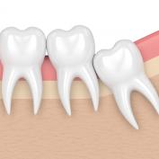 Affollamento dentale