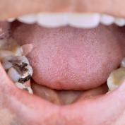 Amalgama dentale