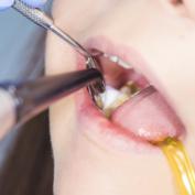 Bonding dentale