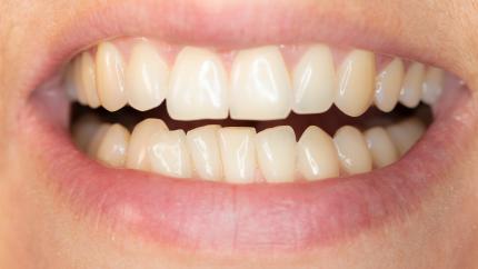 Affollamento dentale grave