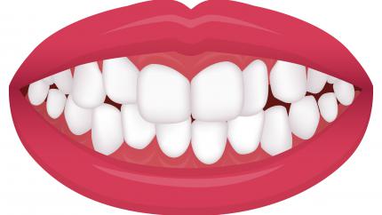 Affollamento dentale