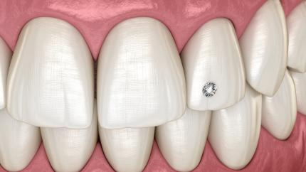 Brillantino al dente