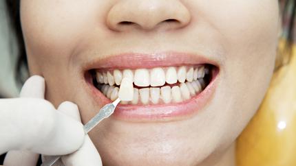 Colore denti