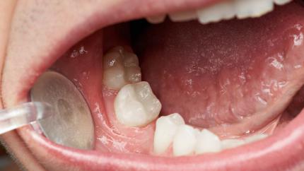 Come nascondere un dente mancante