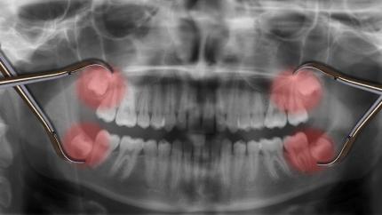 Crescita dente del giudizio