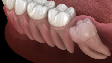 Dente del giudizio a 40 anni