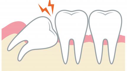 Dente del giudizio incluso