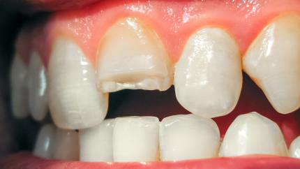 Dente rotto