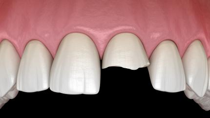 Dente scheggiato