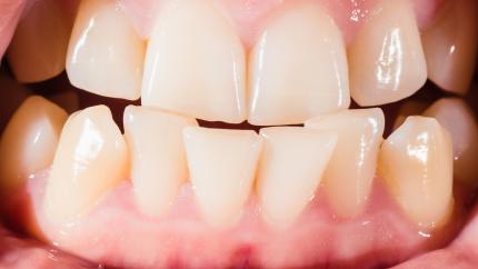 Denti accavallati