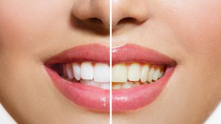 Denti rifatti prezzo