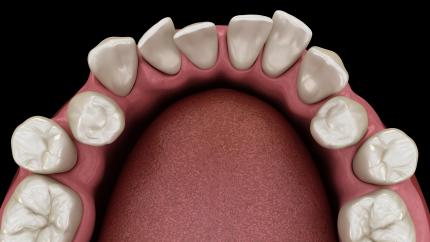 Denti storti