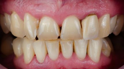 Digrignare i denti da sveglio