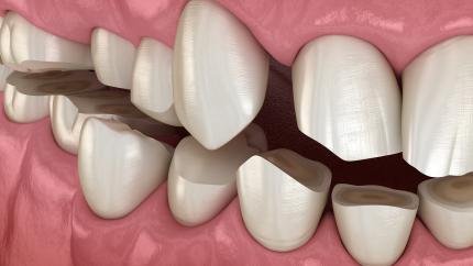 Digrignare i denti