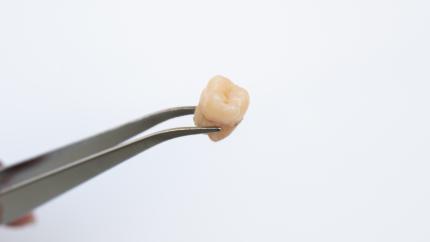 Dolore dopo estrazione dente del giudizio quanto dura