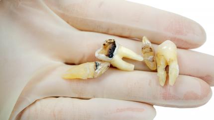 Estrazione dente del giudizio superiore cariato