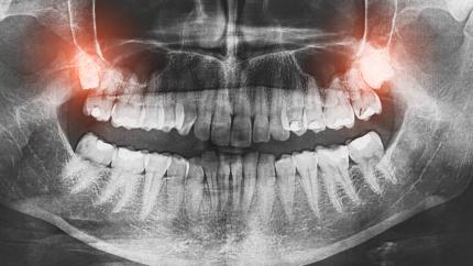 Estrazione dente del giudizio superiore fa male 
