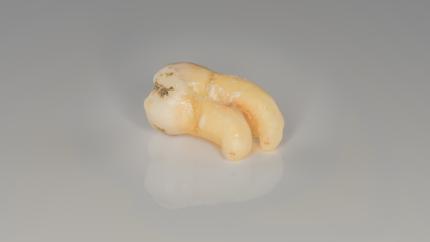 Estrazione dente del giudizio superiore