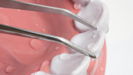 Estrazione dente ghiaccio
