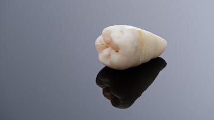 Estrazione denti per sovraffollamento