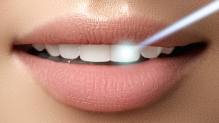 Laser parodontite controindicazioni