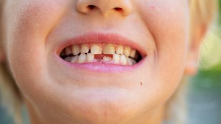 Quali sono i denti da latte