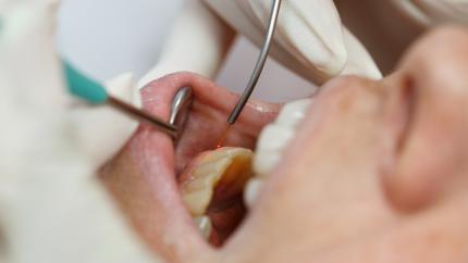 Ricostruzione gengivale laser
