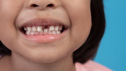 Schema denti da latte