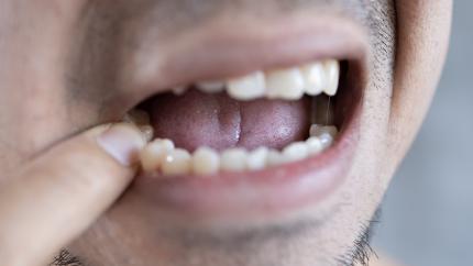 Si può togliere un dente con infiammazione