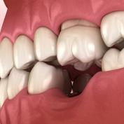 buco dopo estrazione dente