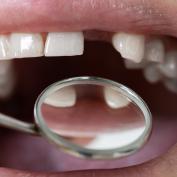 Come nascondere un dente mancante
