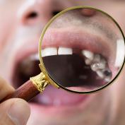 Come nascondere un dente rotto