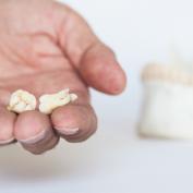 Cosa mangiare dopo estrazione dente
