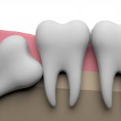 Crescita dente del giudizio