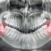 Dente del giudizio a 40 anni