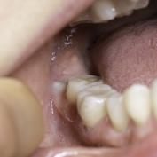 Dente del giudizio quando esce