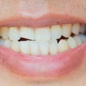 Dente rotto