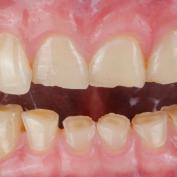 Dente scheggiato ricresce