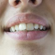Denti accavallati 