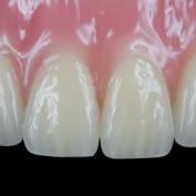 Denti incisivi