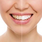 Denti rifatti prima e dopo