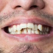 Denti storti