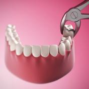 Estrazione dente con granuloma fa male