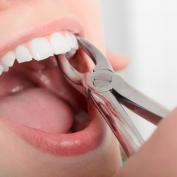 Estrazione dente con infezione sotto