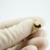 Estrazione dente del giudizio superiore cariato